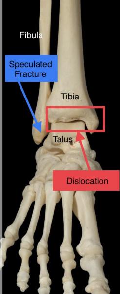 Right Ankle Fracture and Dislocation